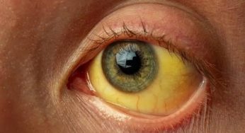 Over 40 Infected in Suspected Jaundice Outbreak in Jagatsinghpur Village